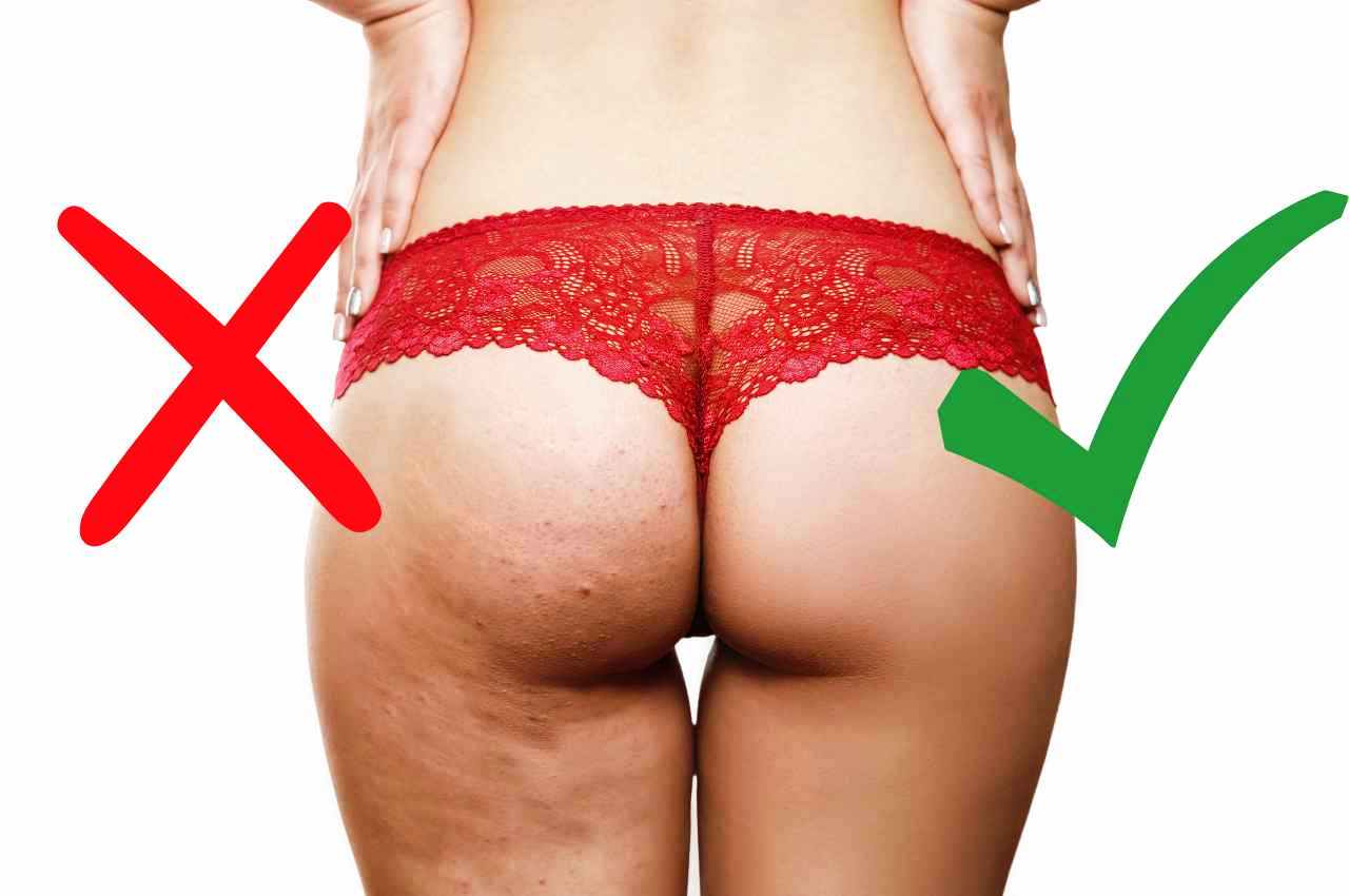 la cellulite si combatte facilmente